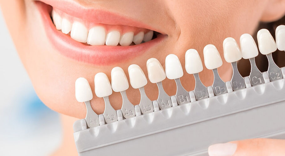 LAMINATES & VENEERS